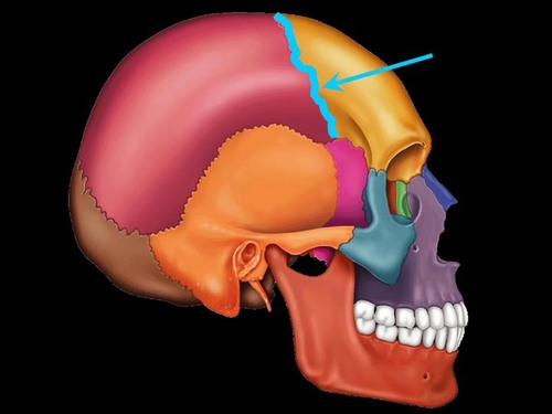 <p>suture between frontal and parietal</p>