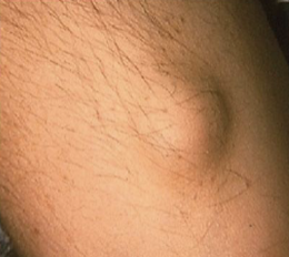 <p>A palpable solid lesion up to 1cm in diameter found in soft tissue; it can occur above, level with, or beneath the skin surface</p>