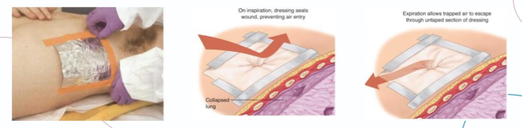 <p>1- three sided occlusive dressing </p><p>2- treat shock if present </p><p>3- supplemental O2</p>