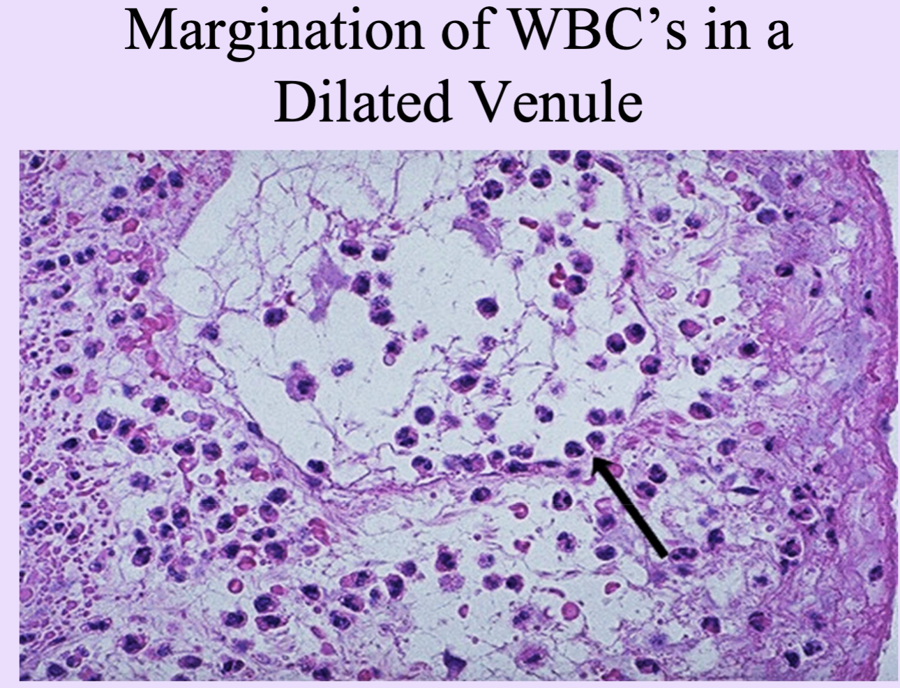 <p>Margination and adhesion of leukocytes to endothelium at sites of injury. WBC</p>