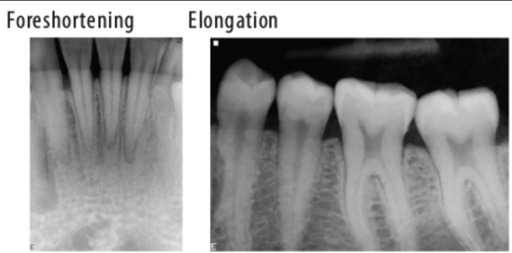<p>What is foreshortening the roots?</p>