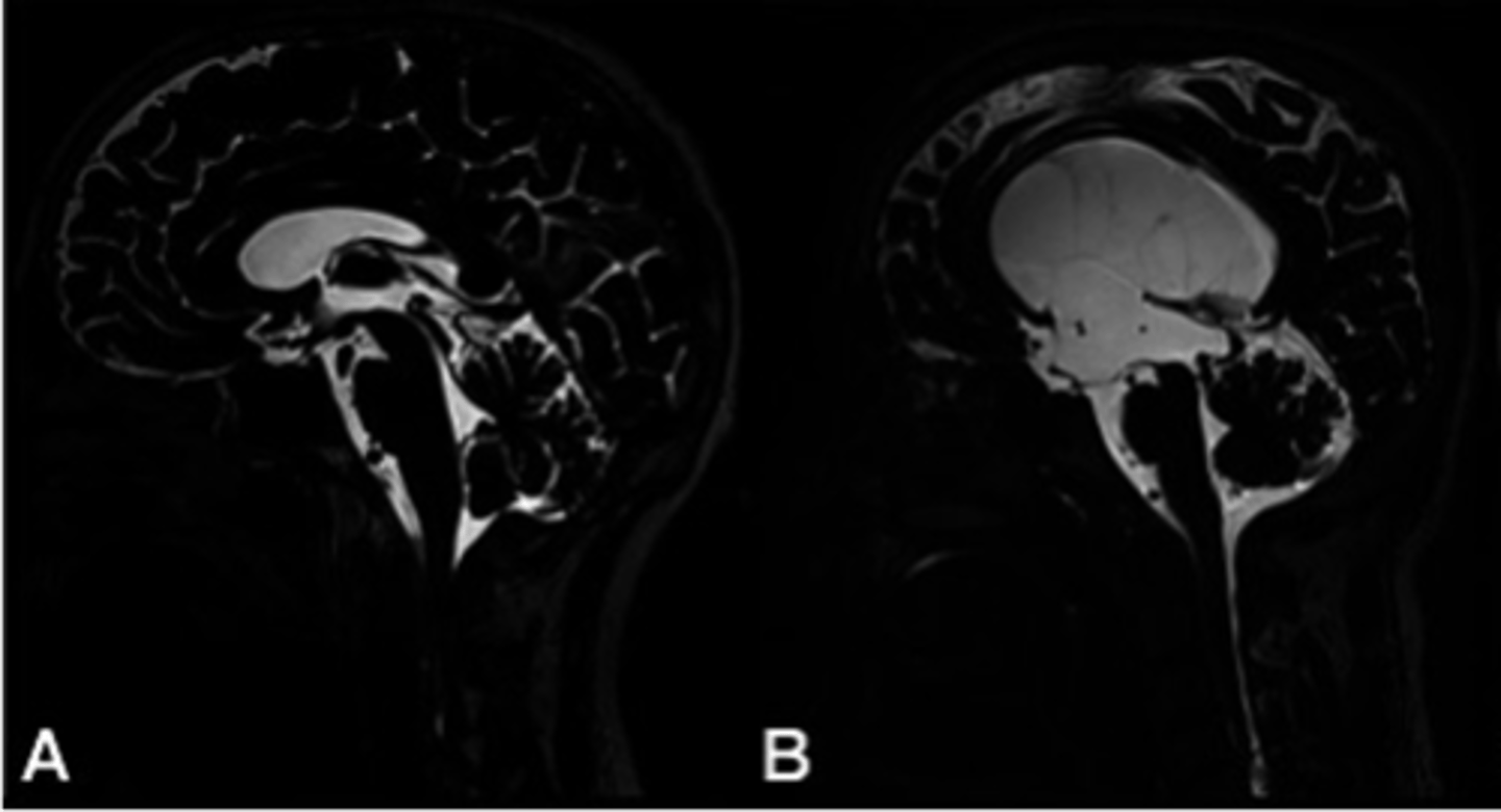 <p>What happens in hydrocephalus?</p>