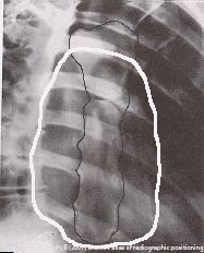 <p>Is the sternum visible in this image? RAO OBL Sternum</p>