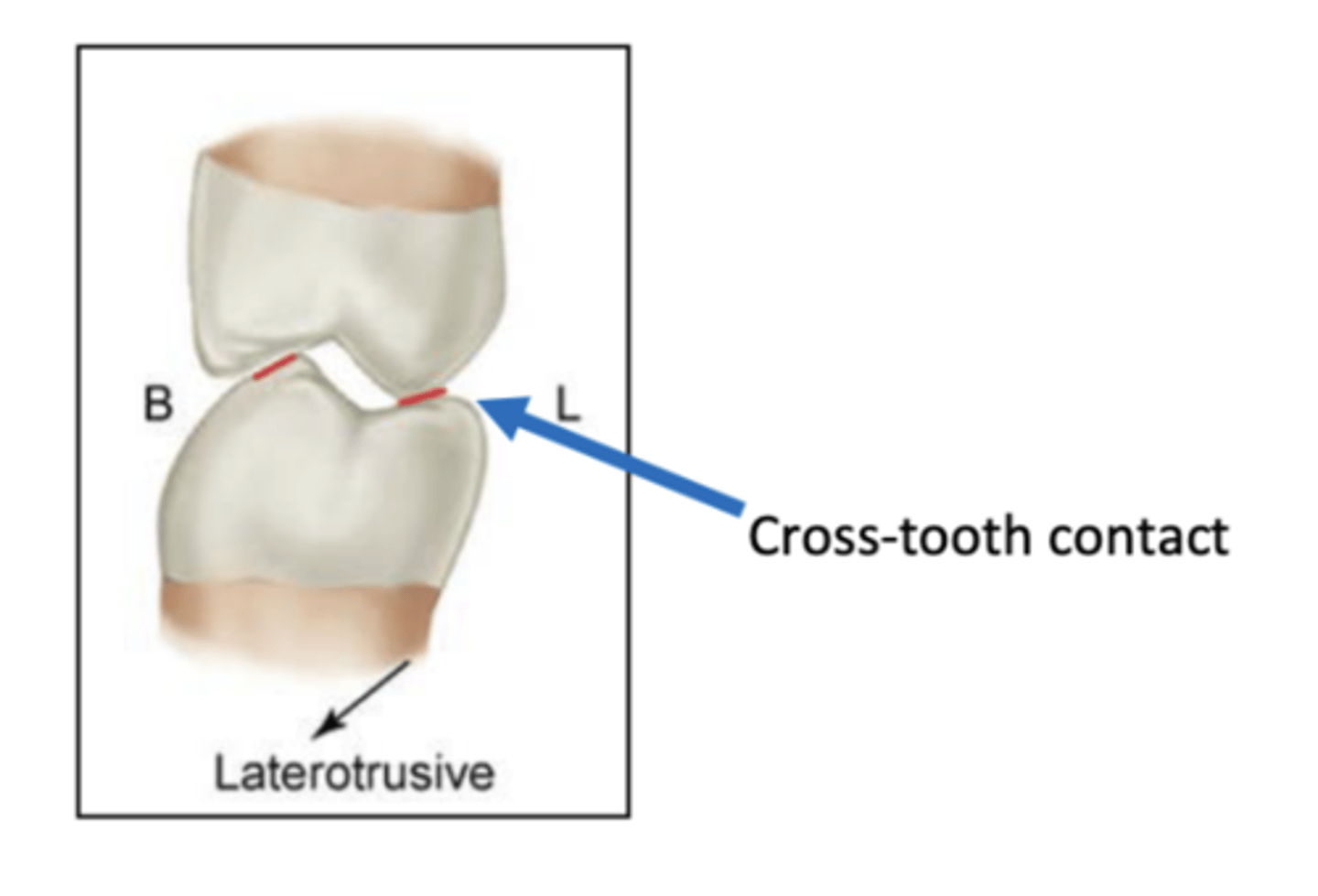 <p>outer incline of upper lingual cusp to inner incline of lower lingual cusp</p><p>not desirable</p><p>second most destructive posterior tooth contact</p>