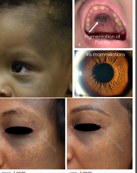 <ol><li><p>Flat, <strong><u>blue-grayish </u></strong>pigmentation of face, periocular skin, conjunctiva and sclera •</p></li><li><p> Tends to follow <strong><u>CN 5 V1 &amp; V2 distribution </u></strong></p></li><li><p>• Can have i<strong><u>ris mammillations </u></strong>—&gt; bumps on iris </p></li><li><p>•<strong><u> Often Unilateral,</u></strong> bilateral in only10% cases </p></li><li><p><strong><u>• Risk of congenital glaucoma </u></strong></p><ol><li><p>• Infiltration of Melanocytes in drainage angle can lead to reduced outflow and increased intraocular pressure </p></li></ol></li><li><p>•<strong><u> Risk of Uveal melanoma</u></strong></p></li></ol><p></p>