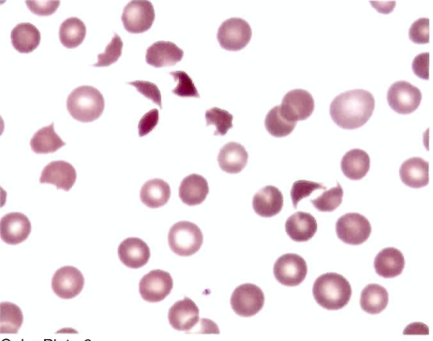 <p>D. Idiopathic thrombocytopenic purpura</p><p>(ITP)$</p>