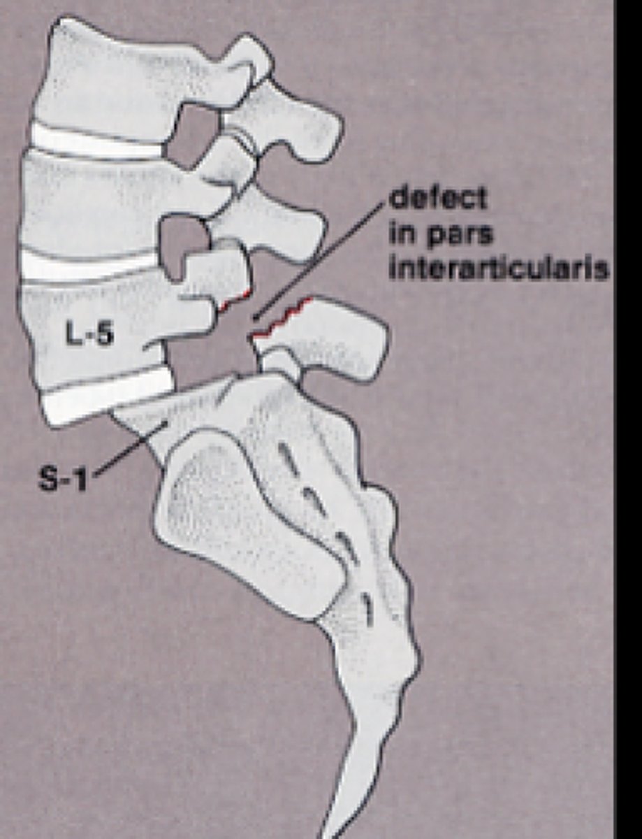 <p>the forward slipping movement of the body of one of the lower lumbar vertebrae on the vertebra or sacrum below it</p><p>TYPES:</p><p>1. congenital</p><p>2. isthmic</p><p>3. degenerative</p><p>__________________</p><p>less common:</p><p>4. traumatic</p><p>5. pathological</p><p>6. post-surgical</p>
