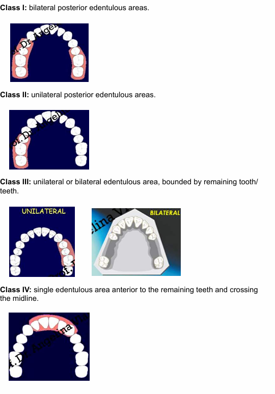 <ul><li><p>class 1 - bilateral posterior edentulous areas</p></li><li><p>class 2 - unilateral posteriro edentulous area </p></li><li><p>class 3 - unilateral or bilateral edentulous area bound by teeth </p></li><li><p>class 4 - anteriro edentulous area </p></li></ul><p></p>