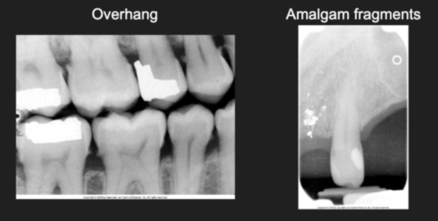<p>- Overhang and amalgam fragments</p>