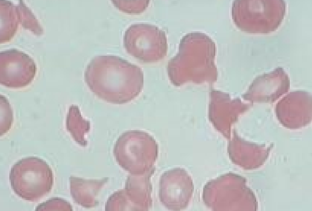 * Fragments formed by passing through fibrin strands or turbulent blood flow
* causes: DIC, Hemangiosarcoma, Vasculitis, Glomerulonephritis, Congestive heart failure, Myelofibrosis, 

  Doxorubicin toxicity, Severe hepatopathy, Iron deficiency, Dyserythropoiesis (dogs)