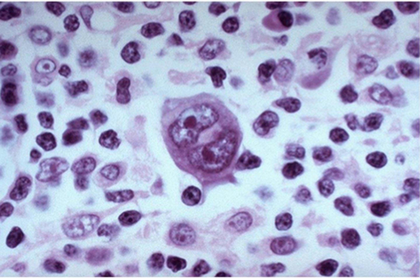 <p>distinguished from other lymphomas by the presence of large, cancerous lymphocytes known as Reed-Sternberg cells</p>