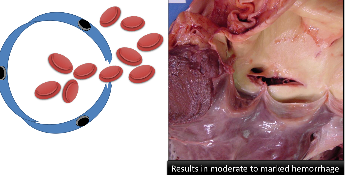 <p>Hemorrhage from a tear in the blood vessel or heart is called what?</p>