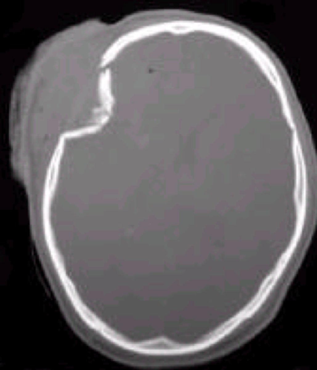 <p>type of skull fracture where a portion of the skull is pushed inward toward the brain due to trauma, often from a direct blow or impact to the head. The fracture can cause the bone to press against the brain tissue, leading to potential injury</p>
