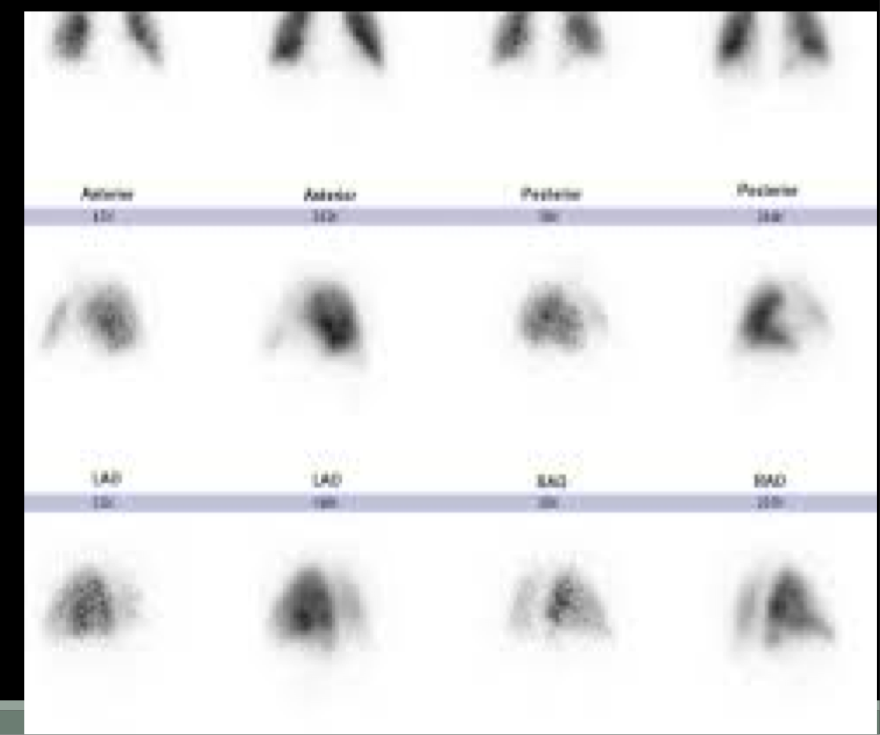<p>99mTc-MAA- these particles get trapped in arterioles in the lungs to show regional perfusion in the lungs </p><p>**99 = nuclear med </p>