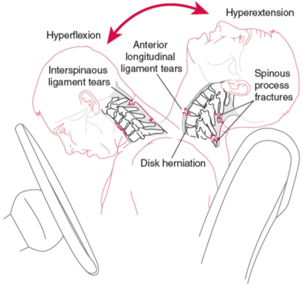<p>- extension injuries are worse in terms of tissue damage and prognosis</p><p>- hyperextension may reach an angle of 140 degrees (normal is 45)</p><p>- in severe cases, patients can have bruising between scapulas from the occiput</p>