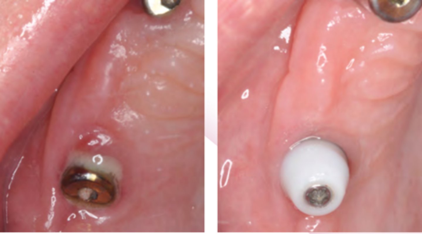 <p>- Current evidence regarding the most effective interventions to recover soft tissue health in patients with peri-implant mucositis is inconclusive. However, the removal of plaque and</p><p>calculus deposits and the re-establishment of effective personal oral hygiene are likely to be important elements of effective treatment</p><p>1. Exclude the presence of peri-implantitis by carrying out peri-apical radiographs to assess peri-implant bone levels compared with the baseline radiograph</p><p>2. Use the Oral Hygiene TIPPS behaviour change strategy to highlight the importance of effective plaque removal and to show the patient how they can achieve this. Encourage the use of oral hygiene aids such as implant floss and interdental brushes. Where applicable, give smoking cessation advice</p><p>3. Remove supra-mucosal and sub-mucosal plaque and calculus deposits using an appropriate</p><p>method. Remove sub-mucosal excess residual cement if this is detected. LA may be required. Highlight to the patient the areas where supra-mucosal deposits are detected.</p><p>4. Re-assess at a future visit to ensure that the inflammation has settled and a stable situation has been achieved.</p>