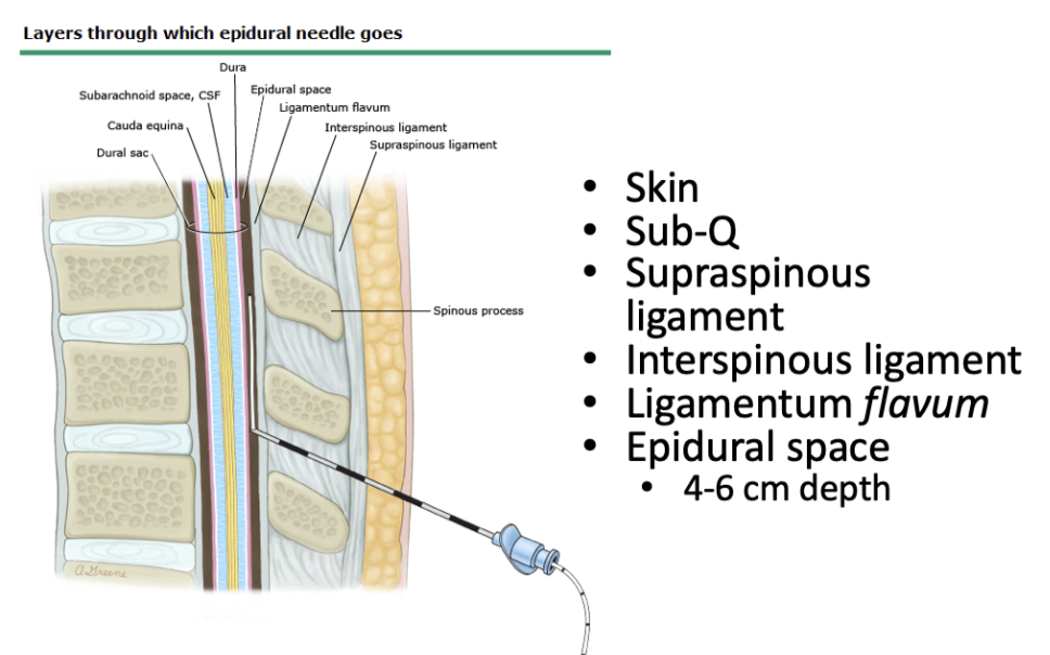 <ul><li><p>skin</p></li><li><p>sub-Q</p></li><li><p>supraspinous</p></li><li><p>Interspinous</p></li><li><p>Flavum</p></li><li><p>Epidrual space</p></li></ul>