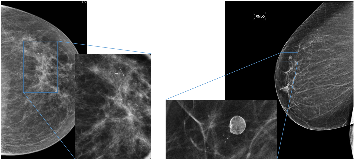 <p>Patient history: screening mammograms in asymptomatic patients </p><p>Modality: mammograms of the left breast in craniocaudal (CC) view (left panels) and of the right breast in mediolateral oblique (MLO) view (right panels), low-energy beam technique (30 kV) + magnified compression images </p><p>Region: breasts</p><p> Radiologic sign: left panels – polymorph microcalcification; right panels – well circumscribed, eggshell calcification</p><p>Diagnosis: invasive ductal carcinoma / benign oil cyst</p>