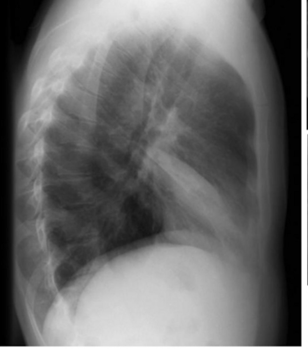 <p>What is this pattern of lung disease?</p>
