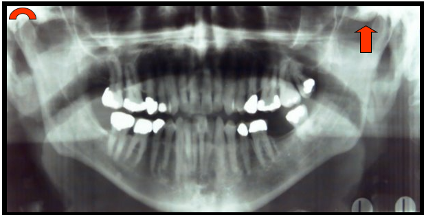 <ul><li><p><span>One appears as a concave radiopacity superior to the mandibular condyle.</span></p></li><li><p><span>One appear as a rounded radiopaque projection of the bone located anterior to the glenoid fossa.</span></p></li></ul><p></p>