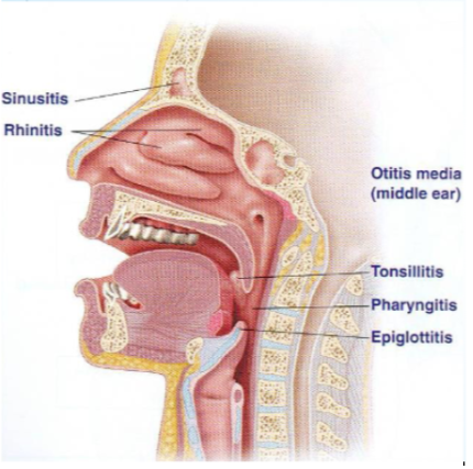 <ul><li><p>sinusitis</p></li><li><p>rhinitis</p></li><li><p>otitis media (middle ear)</p></li><li><p>tonsilitis</p></li><li><p>pharyngitis</p></li><li><p>epiglottitis</p></li></ul><p></p>