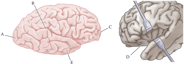 <p>which region is likely to cause hemispatial neglect syndrome when damaged? </p>