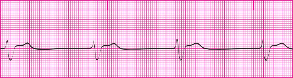 <p> Impulse created by the ventricular pacemaker; SA node &amp; junctional Pacemaker failed to initiate impulse; presents with classic QRS, slow ventricular rate; &amp; no P waves; 20-40bpm</p><p></p><p>Rhythm: R-R interval is regular; P-P interval cannot be determined</p><p>Rate: Ventricular- 20-40bpm; Atrial- Cannot be determined</p><p>P wave morphology: No P wave is present.</p><p>PR interval: Cannot be measured</p><p>QRS duration and morphology: 0.12 seconds or greater; Wide, bizarre appearance</p><p></p><p><strong>**This is a medical Emergency**</strong></p><p>Profound loss of cardiac output</p><p>The patient will likely be unconscious.</p><p>Notify health care practitioner immediately.</p><p>This is a medical emergency.</p><p>Likely to require medication and/or pacing.</p><p>ECG strips must be saved and put in medical record.</p>
