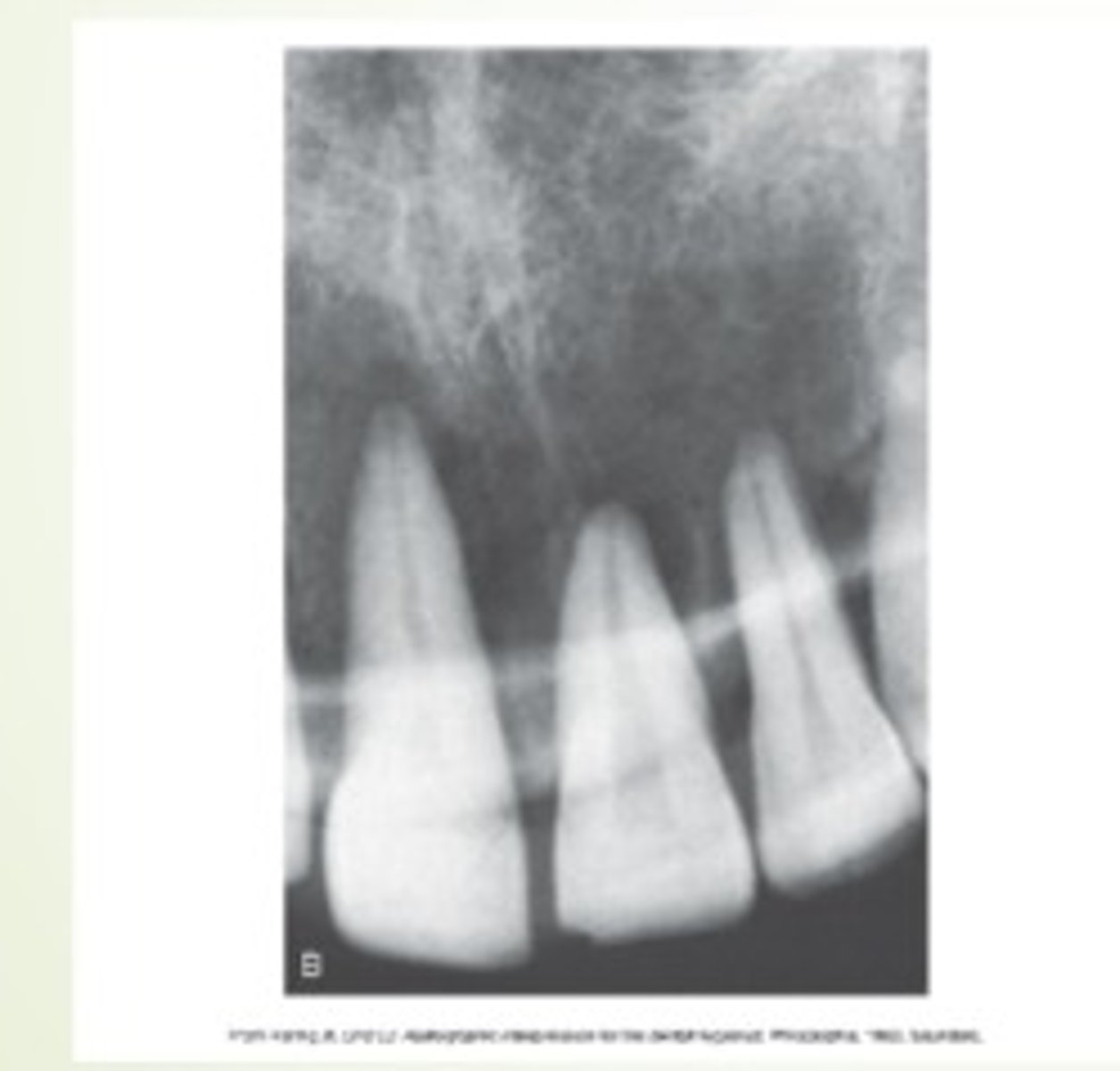 <p>too much vertical angulation will cause ..</p>
