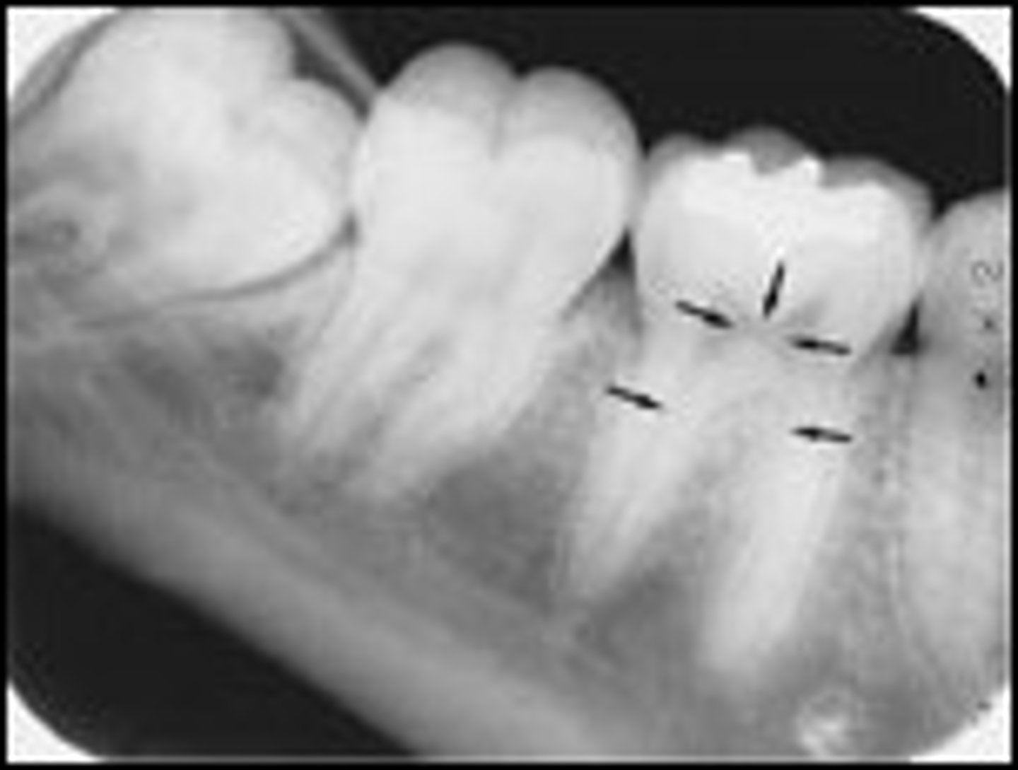<p>What is the radiolucent structure shown here?</p>