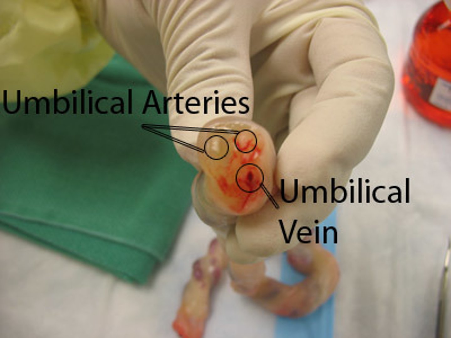 <p>A</p><p>At birth, the umbilical cord is white and contains two umbilical arteries and one vein inside the Wharton jelly. The umbilical stump dries within a week, hardens, and falls off in 10 to 14 days. Skin will cover the area in 3 to 4 weeks</p>