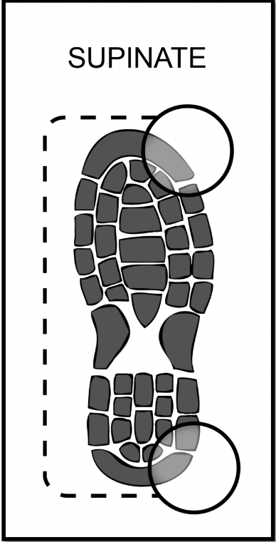 <p>Wear pattern on the outside of the shoe (pointing away from the body)</p>