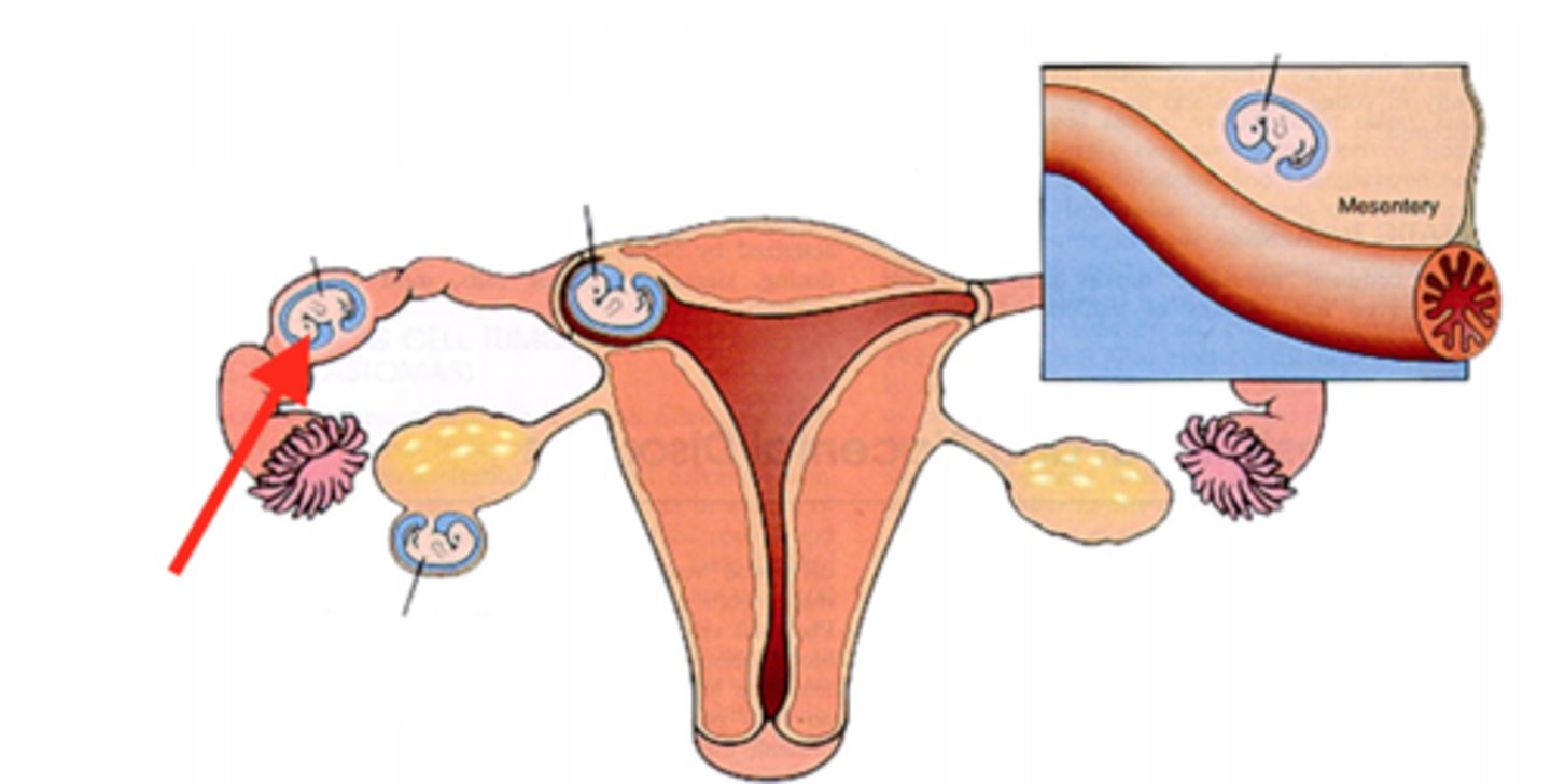 <p>pregnancy in the fallopian tube</p>
