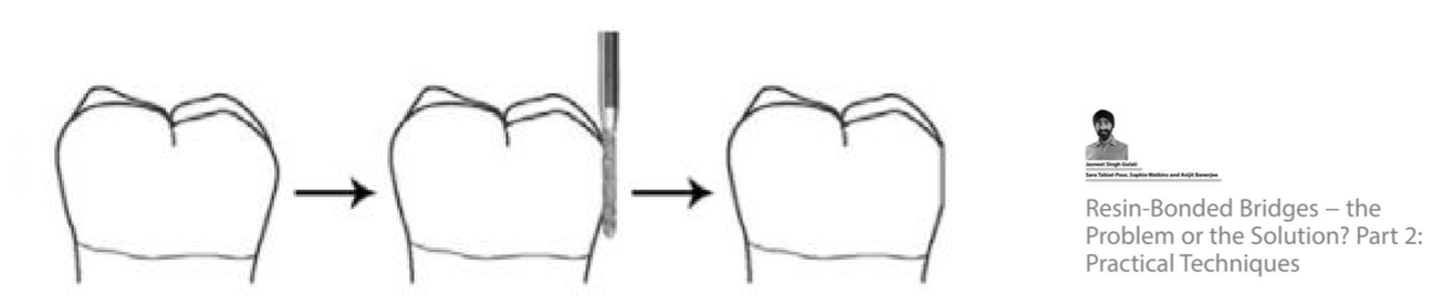 <ol start="2"><li><p>Bond to enamel is strongest and therefore essential for success: </p></li></ol><ul><li><p>Abutments should be minimally restored with resin composite or un-restored </p></li><li><p>Prepare tooth within enamel only to optimize bond and protect from recurrent caries</p></li><li><p>avoid complex preparations such as rest seats and slots which complicate the procedure and risk dentine exposure</p></li><li><p>avoid occlusal preparation - cement high in occlusion if necessary </p></li></ul><p></p>