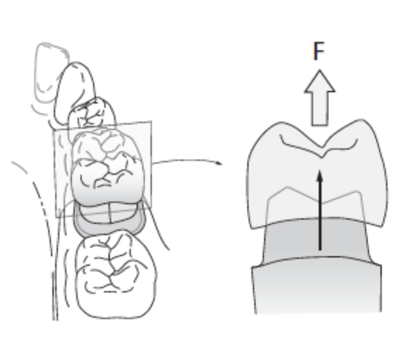 <p>prevents removal of the restoration along the path of insertion or long axis of the tooth preparation&nbsp;</p>