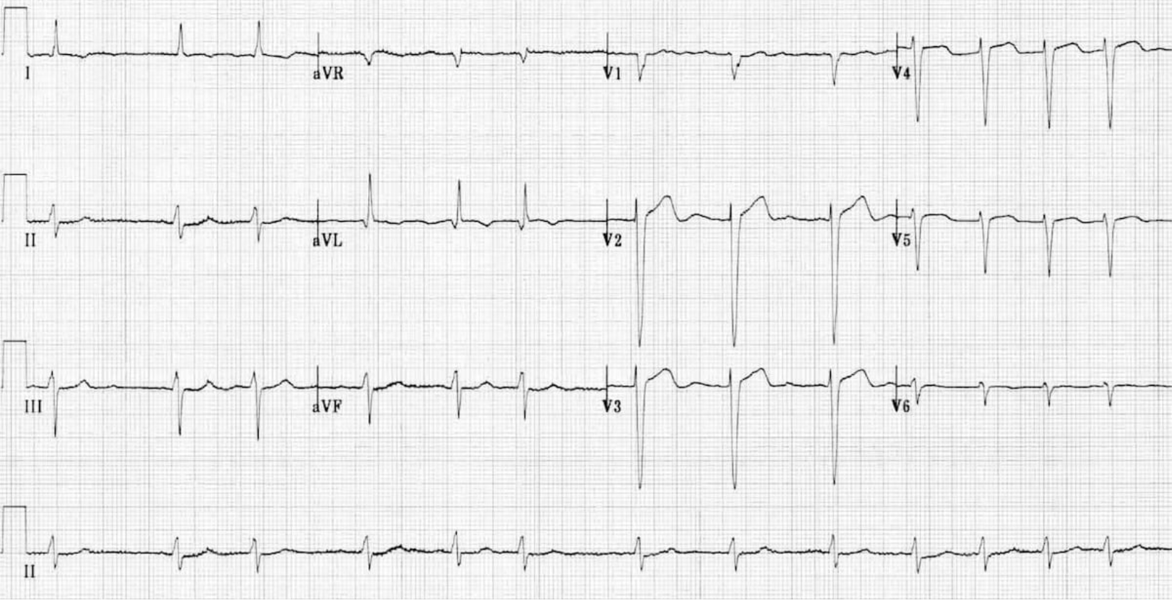 <p>Patient presents to the ED with SOB and fatigue. On a physical exam you note JVD with a positive Kussmaul sign and edema. An EKG is provided by your amazing ED tech. What are some of the key diagnostic tools you want to use?</p>