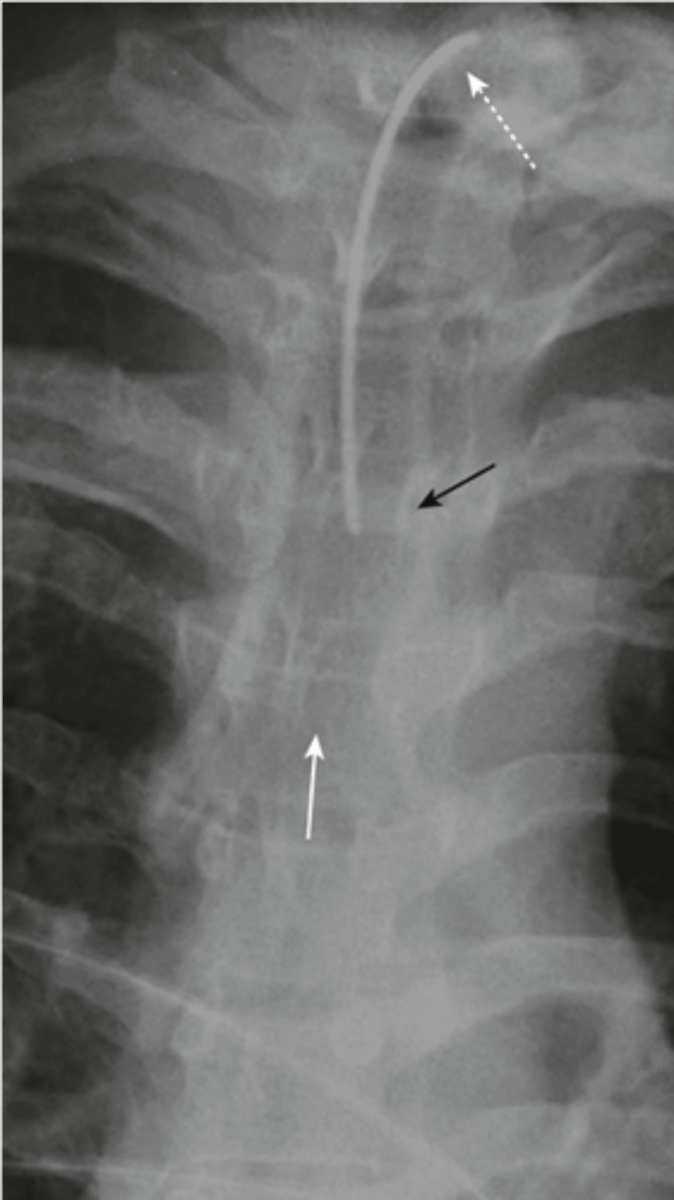 <p>-tip halfway between stoma and carina (T3 level)</p>
