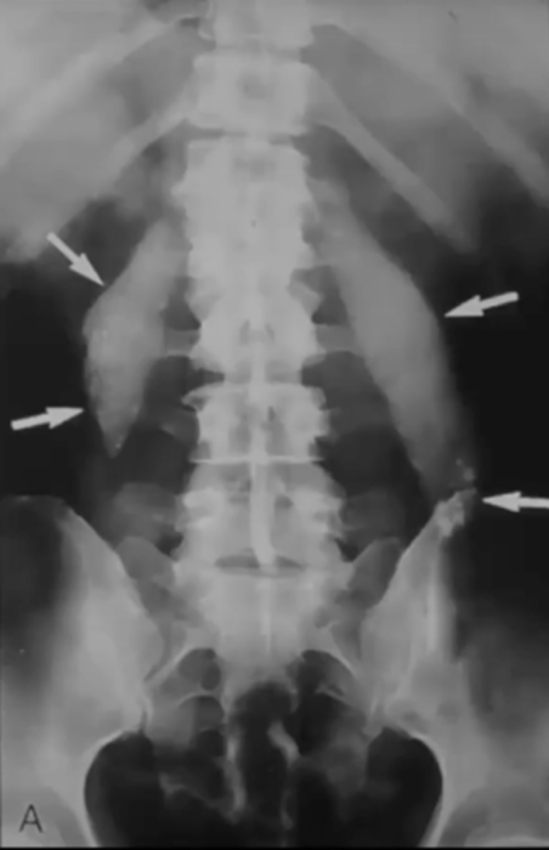 <p>What is this?</p><p>Ex. Calcification of Psoas + TB infection</p>