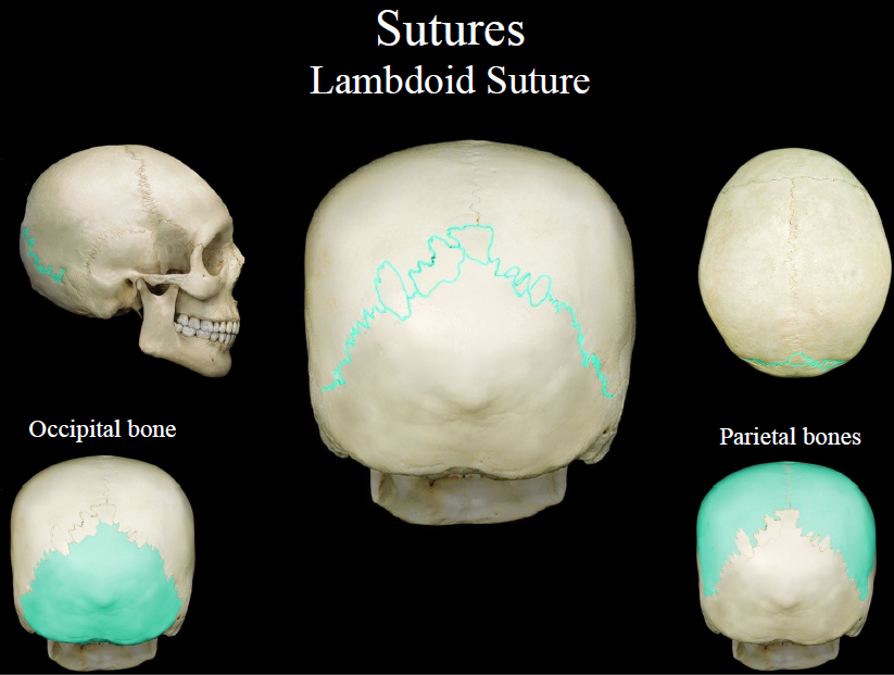 <p>suture between the parietal and occipital bones</p>