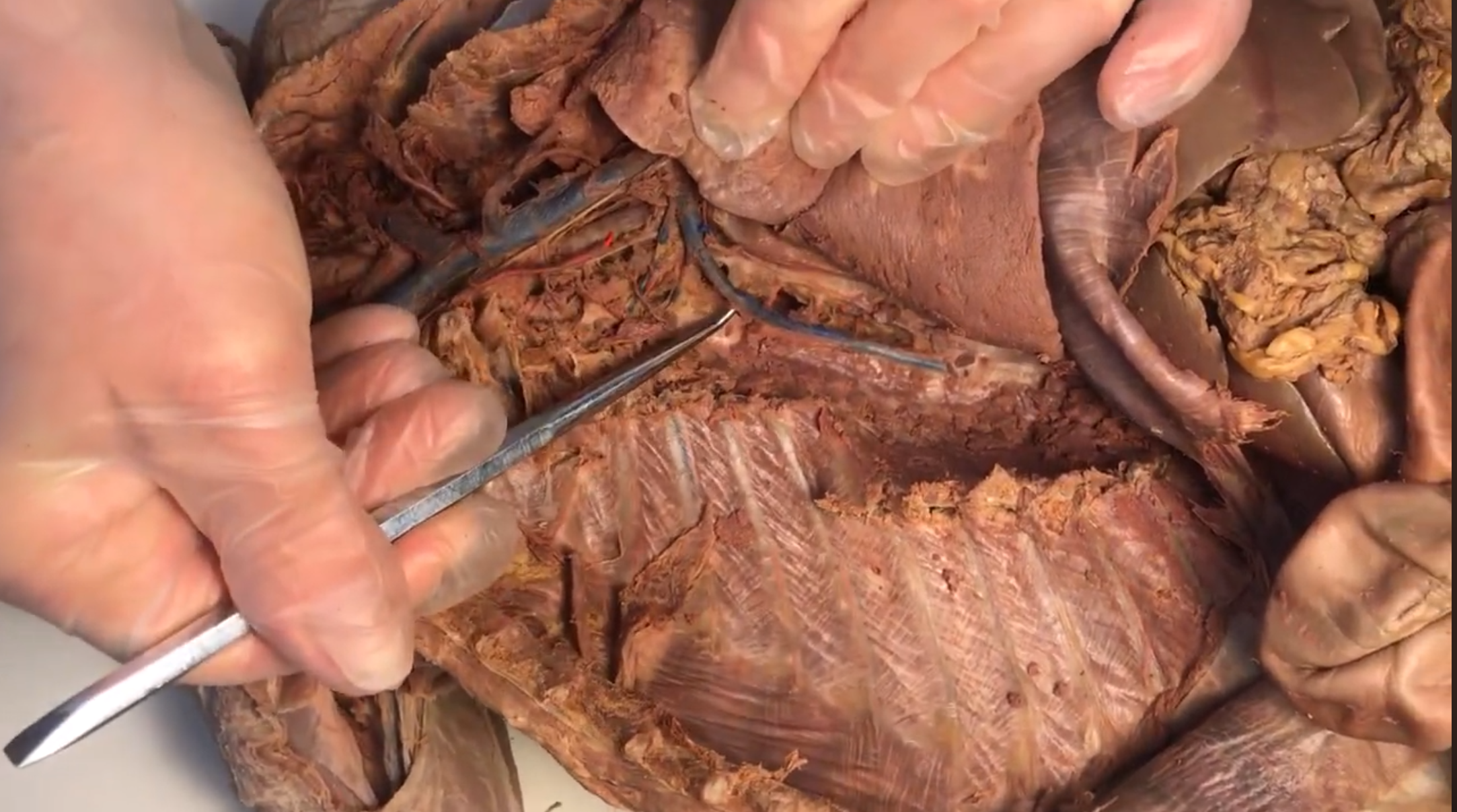 <p>What vein is this</p>