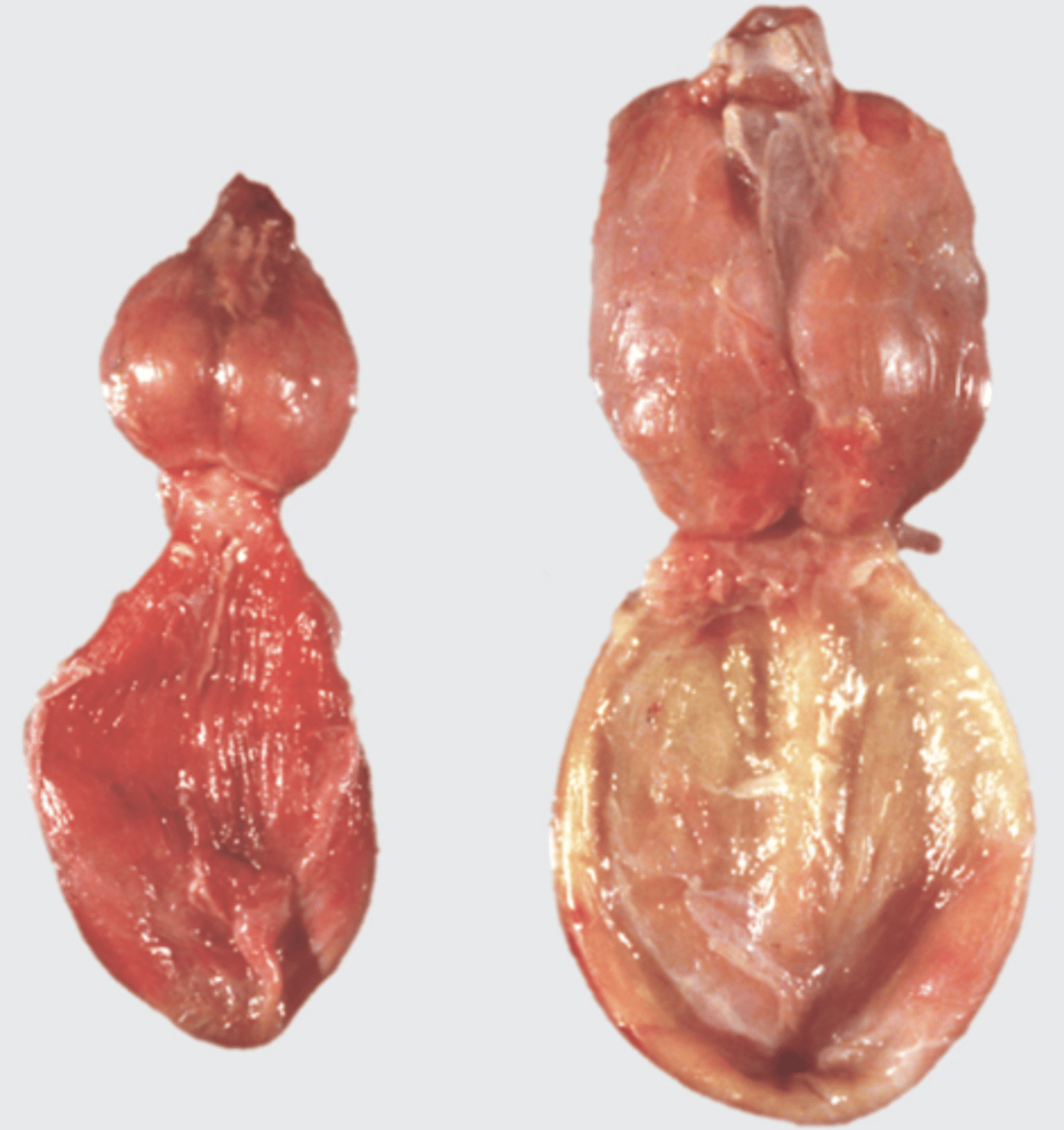 <p>Bilaterally, symmetrically larger prostate</p>