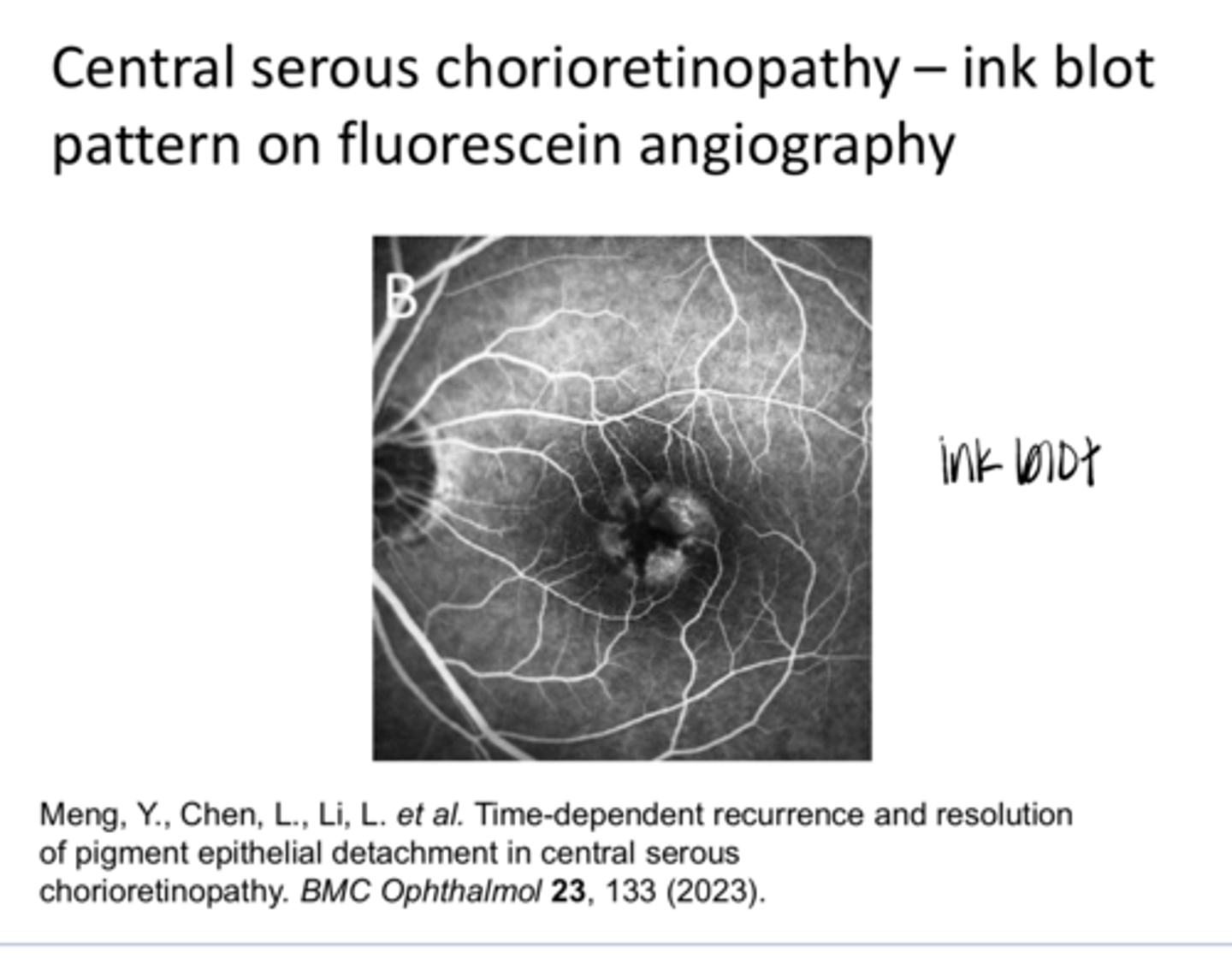 <p>EXAM QUESTION: Central Serous retinopathy is (hyper/hypo) fluorescent on FANG</p>