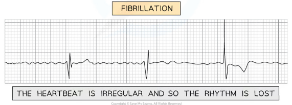 <ul><li><p>irregular heartbeat→ rhythm is lost</p></li></ul>