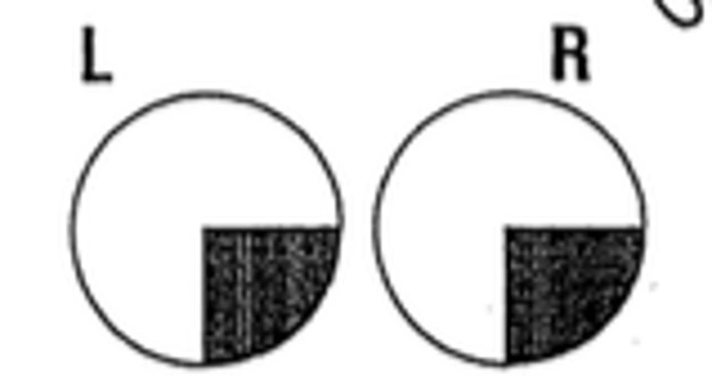 <p>"Pie on the floor" - Damage to superior optic radiation; Lesions of the optic radiations include infarcts, tumors, demyelination, trauma, and hemorrhage</p>