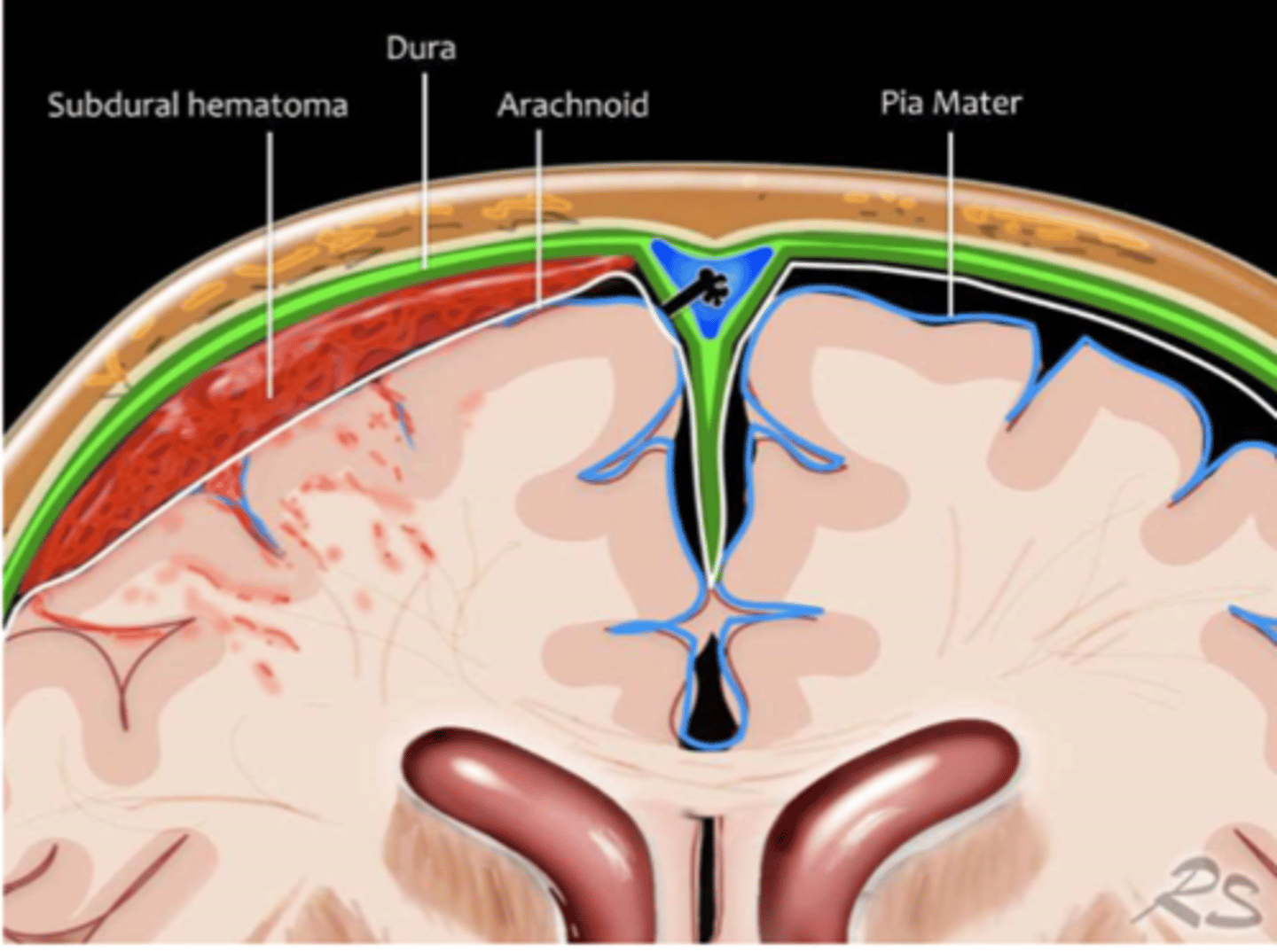 <p>bleeding between inner layer of dura and arachnoid mater.</p><p>-Often occurs rupture of cortical bridging veins</p><p>--Head trauma, anticoagulants, elderly, alcoholics with brain atrophy</p><p>-<strong>Appears concaved, crescent-shaped on head imaging</strong></p>