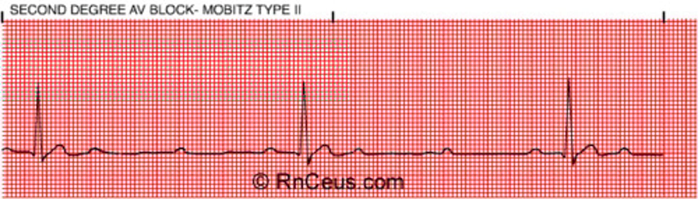 <p>- normal PRI then sudden drop of QRS</p><p>- P wave doesn't always produce QRS</p><p>- P-R interval is constant (diff from 3rd degree)</p><p>- no hint just drops out -&gt; is serious and dangerous pt needs tx!</p><p>- tend to be every other, so drops HR by 1/2) --&gt; def bradycardia (rate=40bpm)</p>