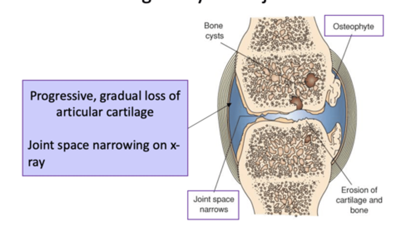 <p>Loss of cartilage in synovial joints</p><p>Damaged joint cartilage tries to heal itself</p><p>-- Creating osteophytes or spurs</p><p>-- Cartilage contains more water, less collagen</p><p>-- Cartilage becomes weak, rough, eroded</p>