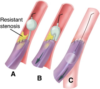 <p>what type of thrombectomy is this and what types of vessels is it used on </p>