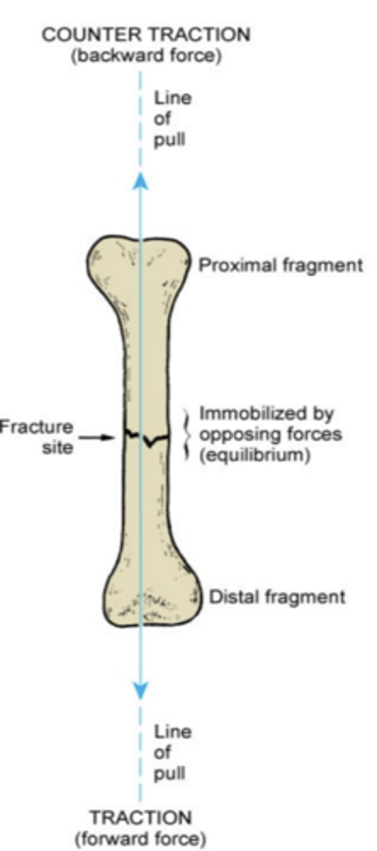 <p>Pulling force to part of body to position and hold bone fragments in correct alignment</p><p>-immobilizes fracture site, reduces muscle spasms</p>