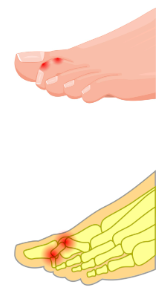 PIP and DIP in flexion