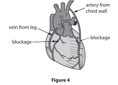<p>Figure 4 shows how bypass surgery can treat blockages in the coronary arteries. Bypass surgery involves a transplant operation.&nbsp;</p><p>Explain two advantages of using blood vessel tissue taken from the patient, rather than tissue taken from a donor. (4)</p>